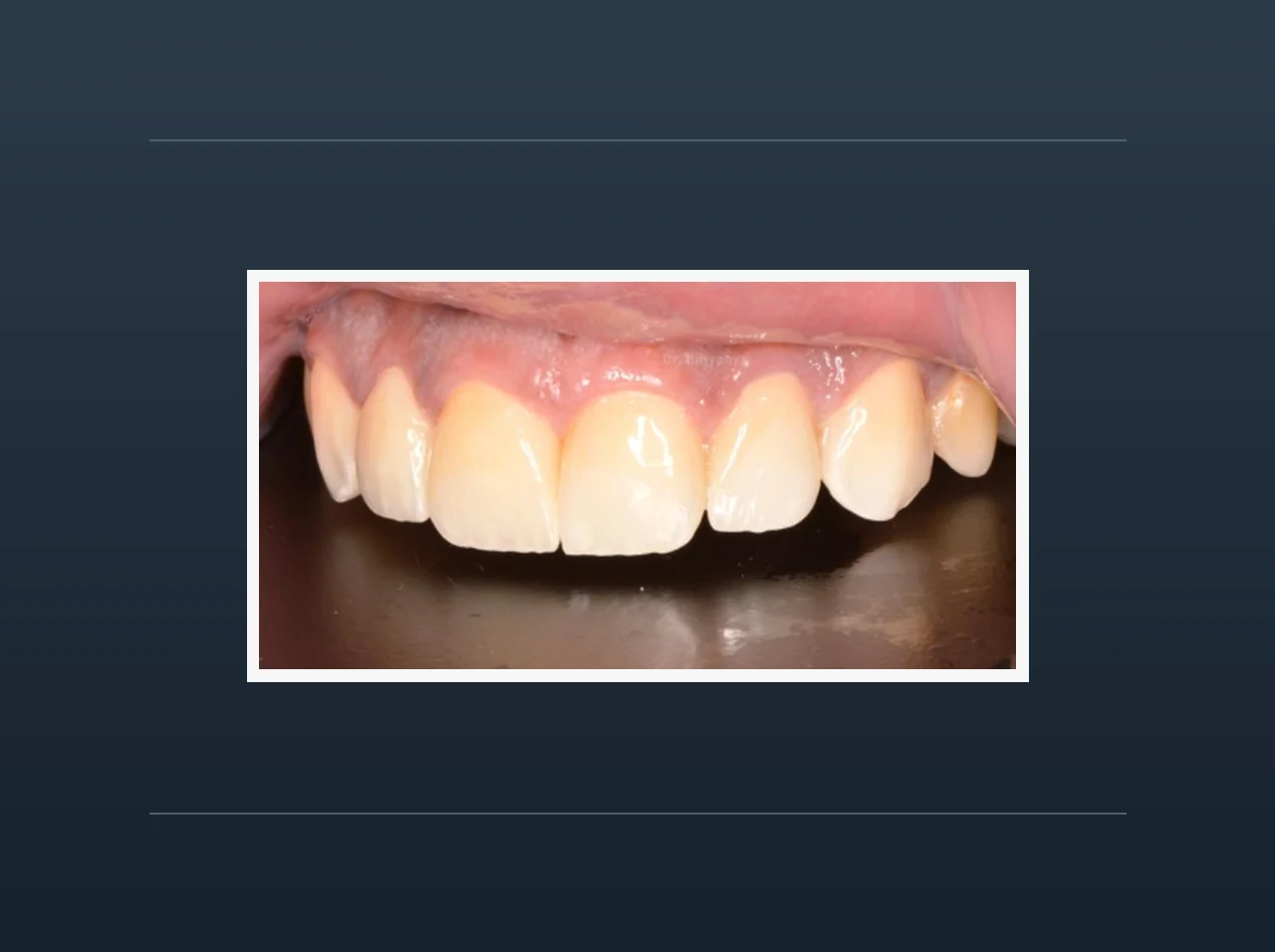 صورة من أعمال العيادة في تجميل الأسنان الأمامية العلوية، في إطار أبيض على خلفية كحلية